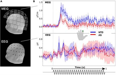 Magnetoencephalography and electroencephalography can both detect differences in cortical responses to vibrotactile stimuli in individuals on the autism spectrum